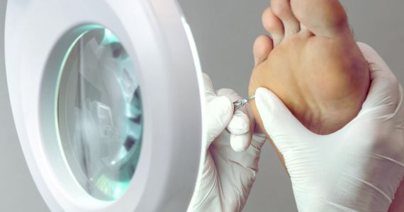 Tratamiento de papiloma en el pie